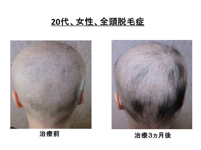 円形脱毛症　病院""